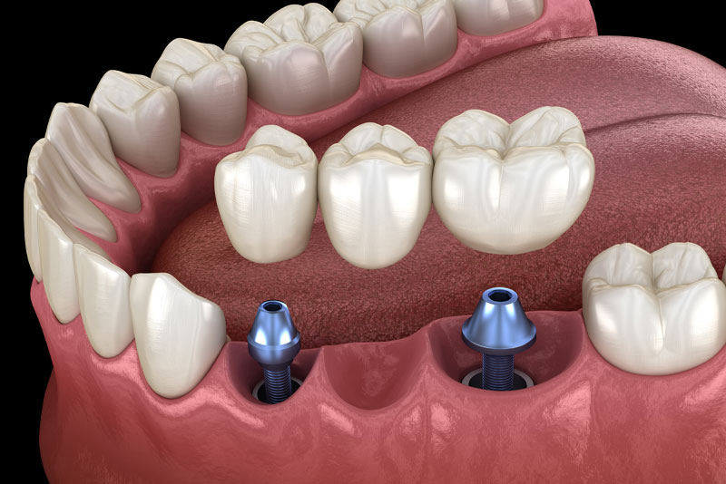 Single Implants model